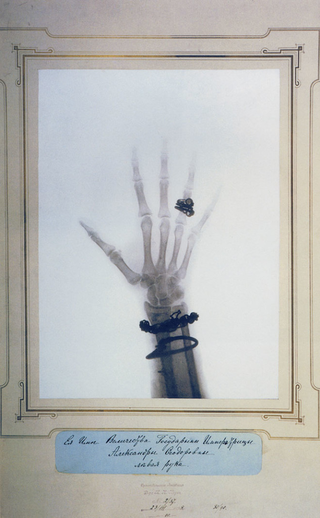 Right hand and wrist of Empress Alexandra Feodorovna.