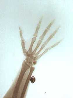 The right hand and wrist of Tsar Nicholas II